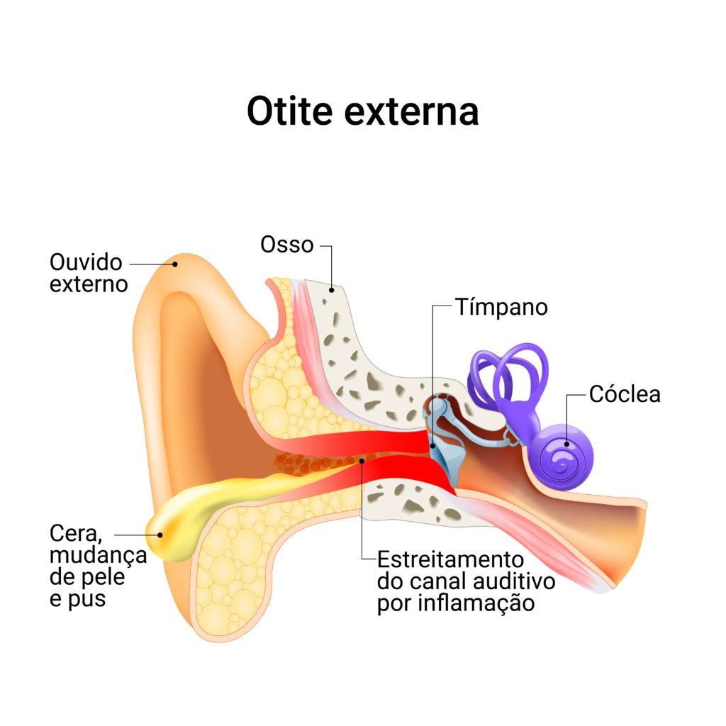 Explicação de onde ocorre a otite